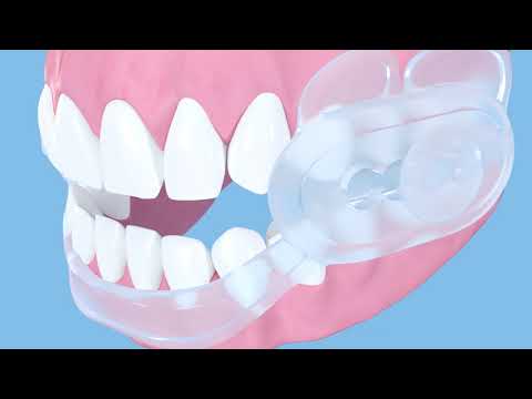 Bruxism Mouth Guard - Key Features